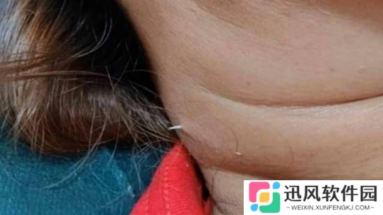 女子被鱼刺卡喉2周 最终鱼刺从脖子穿出